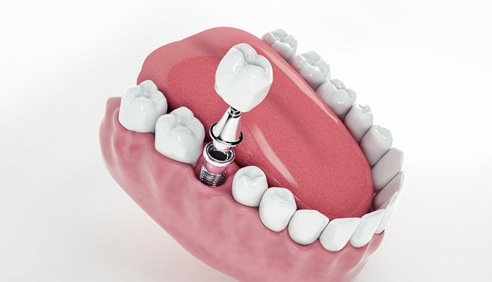 Implantes Dentários