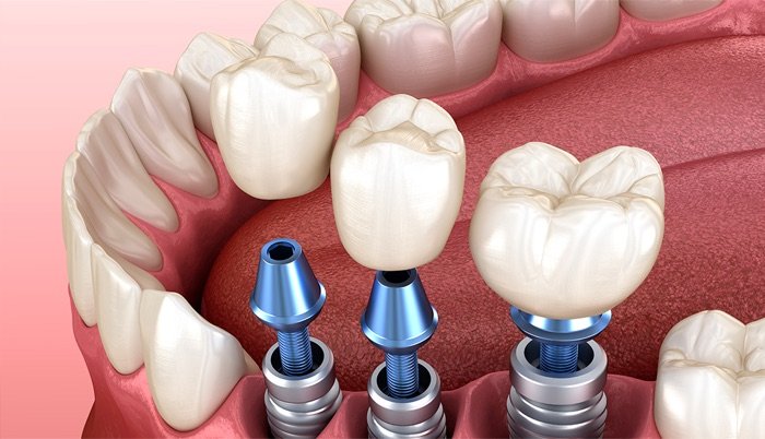 Próteses Dentárias